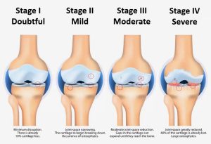 Utvikling av artrose
